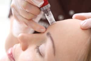 Microneedling with PRP in NYC