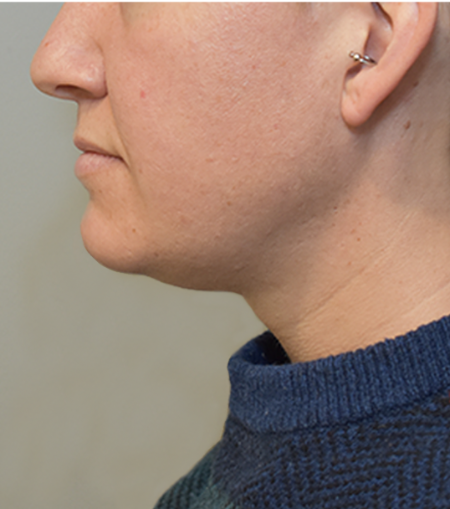 Kybella Patient #20 After Photo # 4