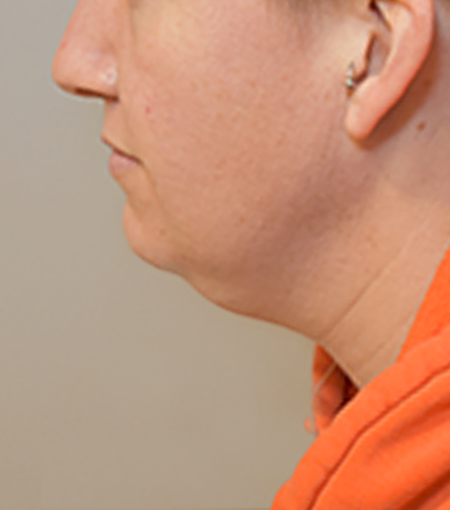 Kybella Patient #20 Before Photo # 3
