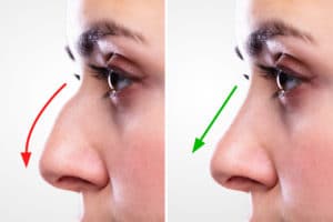 Woman's Nose Before And After Plastic Surgery With Red And Green Arrows