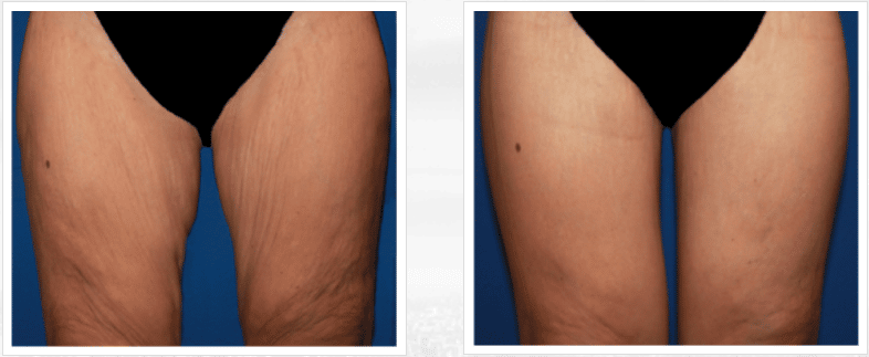 A before and after image set of a woman that received a thigh lift