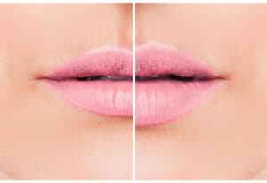 Woman lips before and after lip filler injections. Fillers. Lip augmentation beautiful perfect Lips. Pink mouth, beautiful woman lips close up