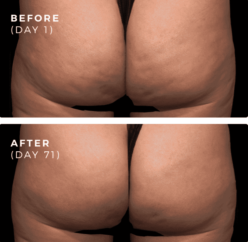 Cellulite on hotsell butt and thighs