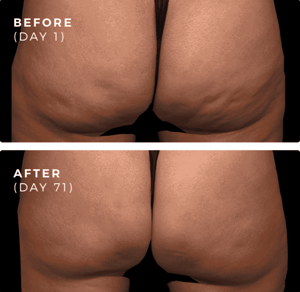 QWO Cellulite Treatment in NYC