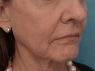 Before Image of Dermal Facial Fillers NYC