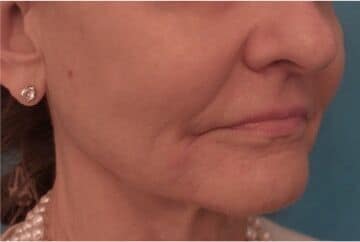 After Image of Dermal Facial Fillers NYC