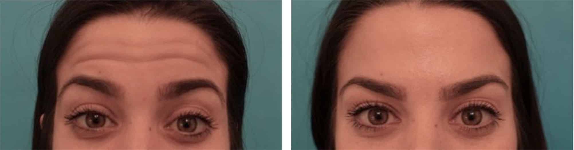 Before and After Image of Botox NYC
