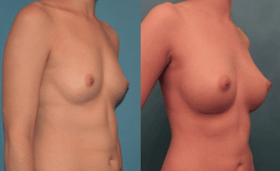 Before and After Image of Breast Augmentation NYC