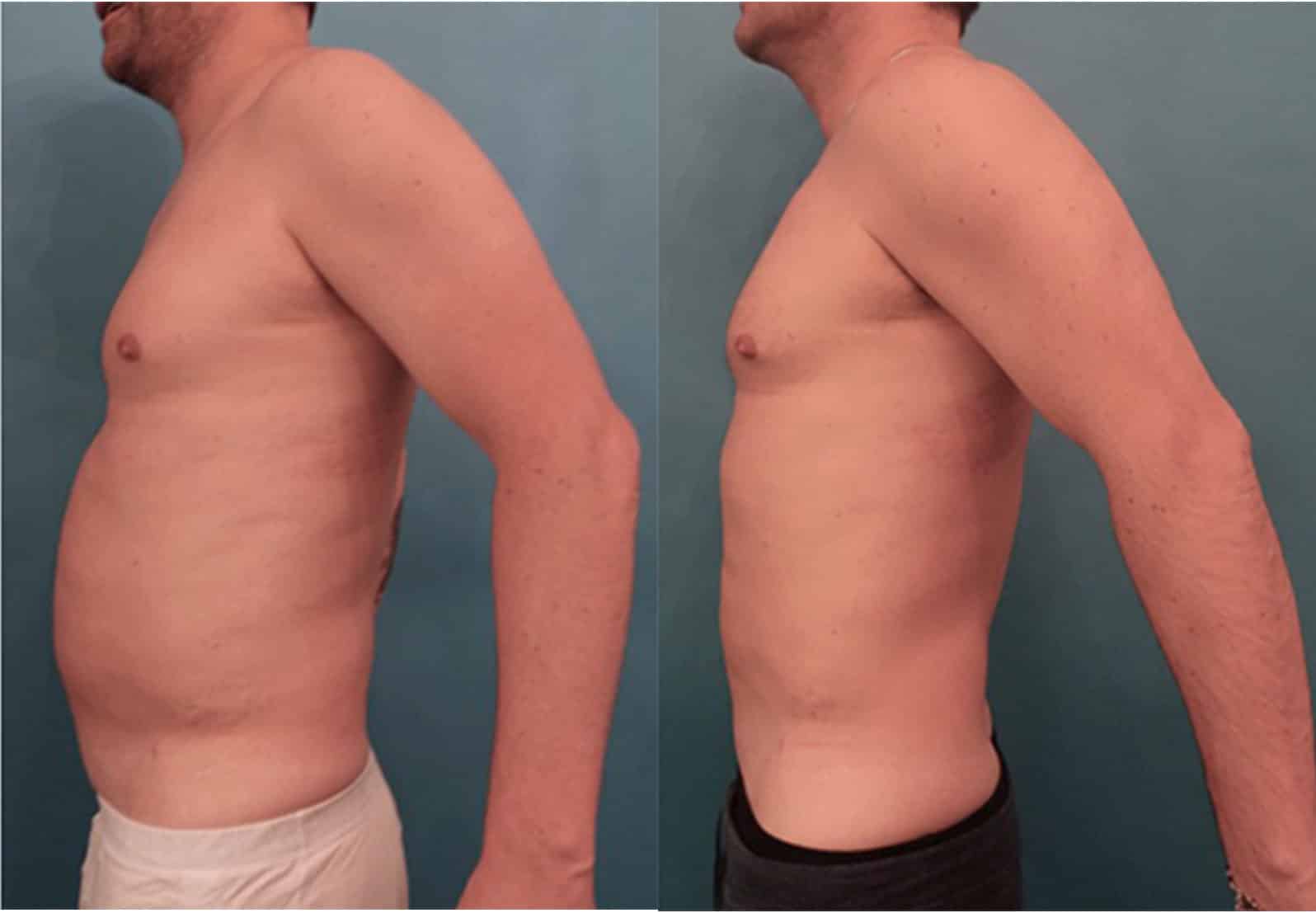 Before and After Image of Body Contouring NYC