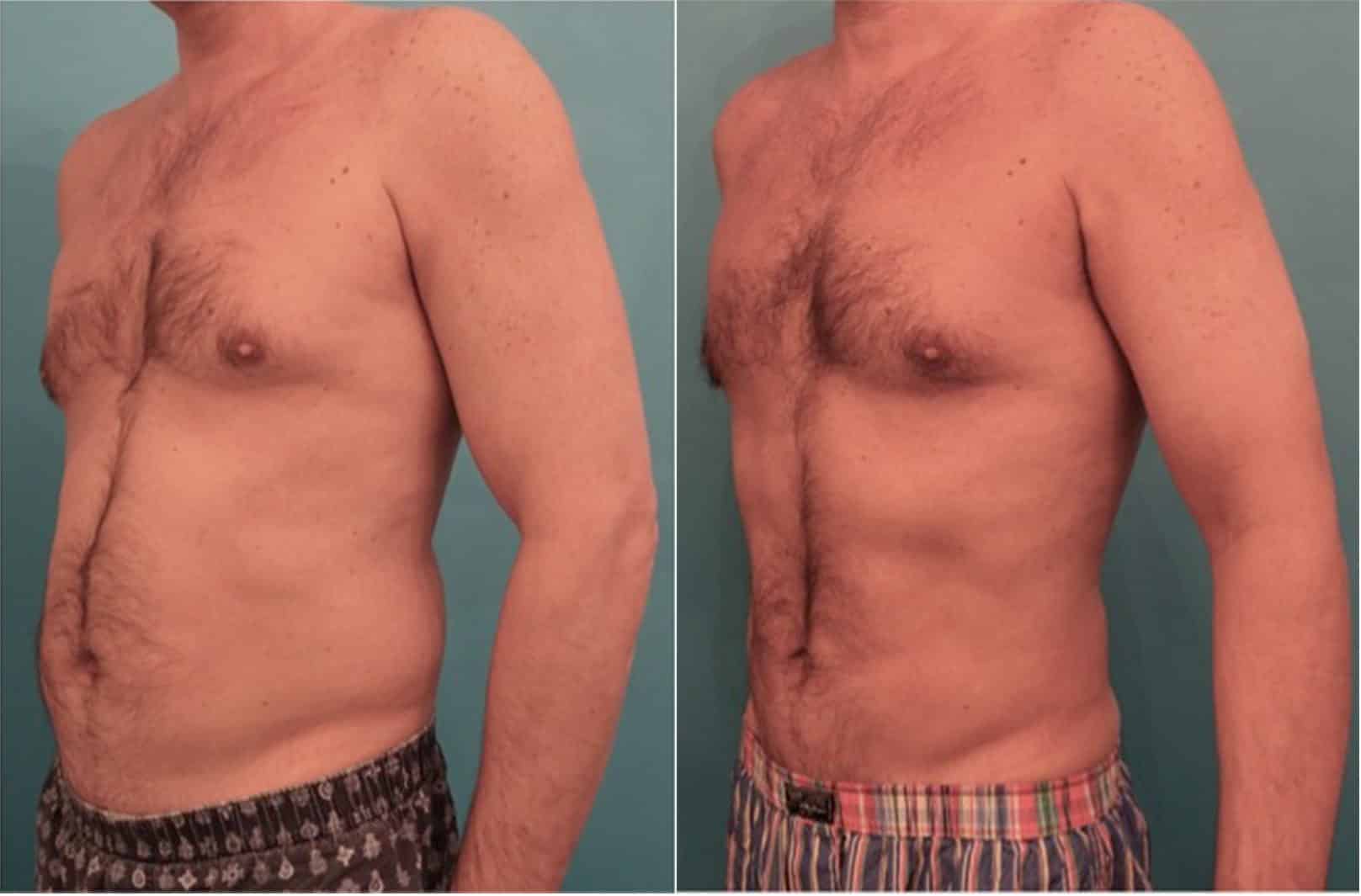 Before and After Image of Liposuction NYC