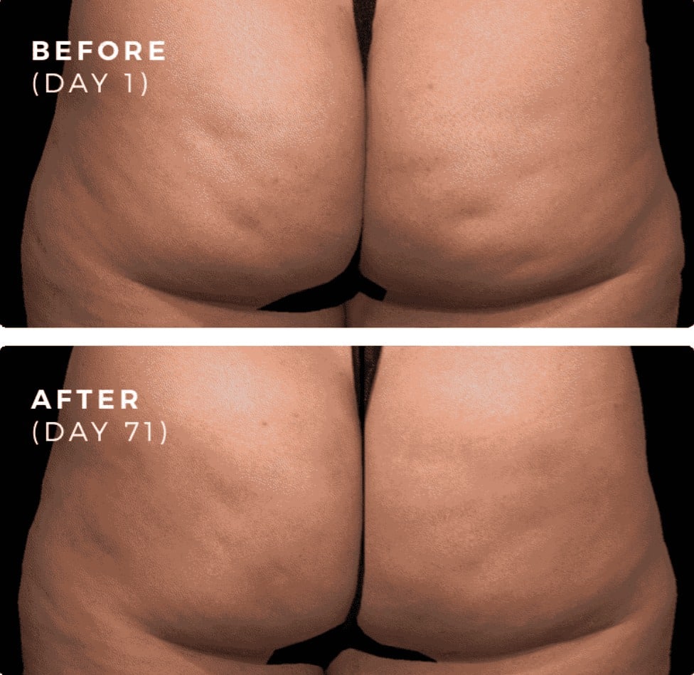 Before and After Image of QWO Injectable Treatment NYC