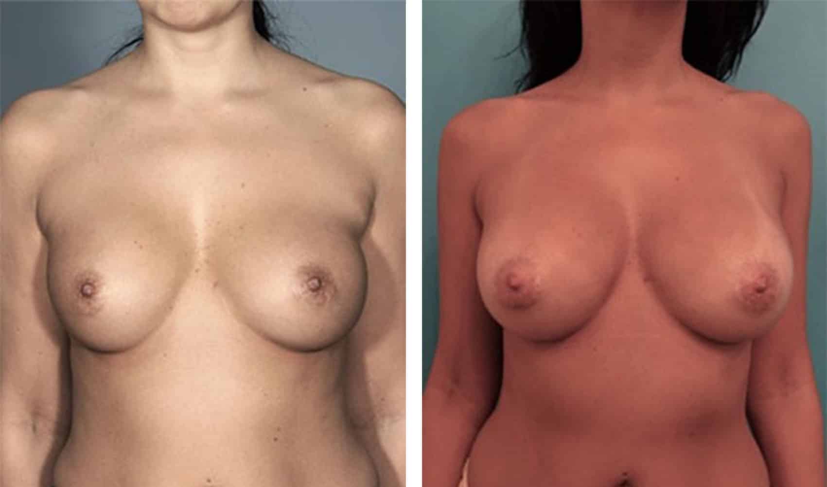 Before and After Image of Breast Augmentation NYC