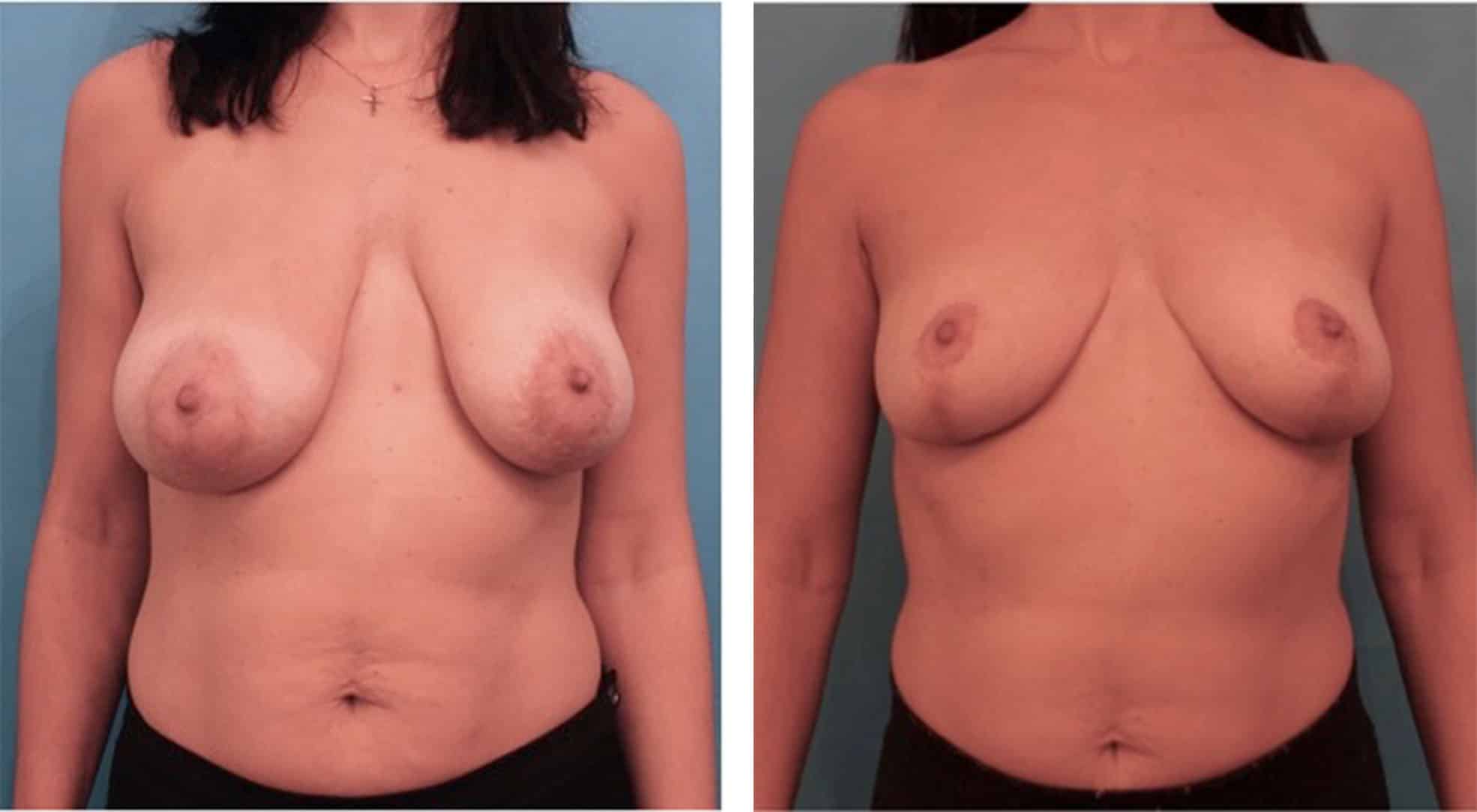 Before and After Image of Breast Lift NYC