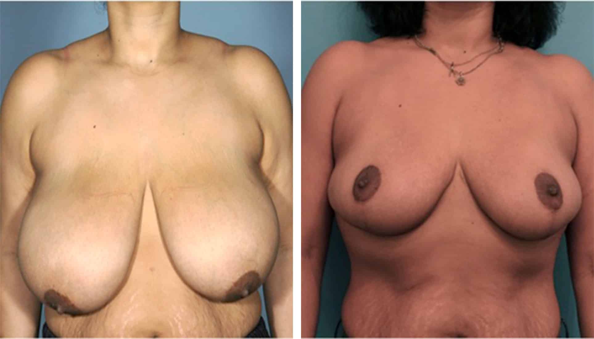Before and After Image of Breast Reduction NYC