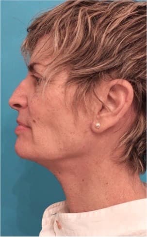 After Image of Necklift NYC