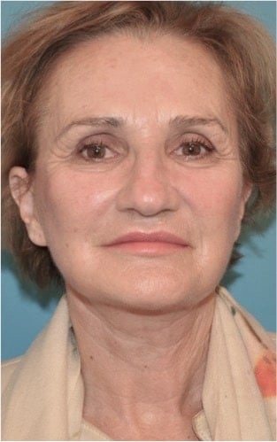 After Image of Facelift NYC
