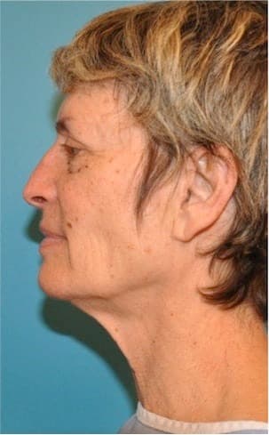 Before Image of Necklift NYC