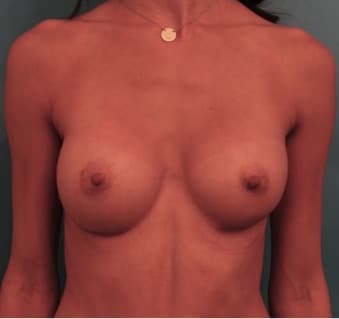 Breast Augmentation After Patient NYC