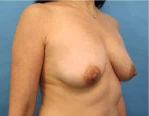 Before and After Image of Breast Lift NYC