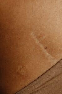 Scar revision