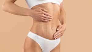 Tummy tuck patient showing off her newly sculpted physique