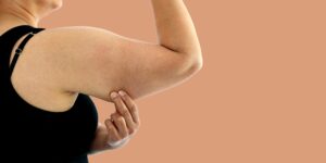 Excess arm skin treated with plastic surgery after weight loss New York, NY
