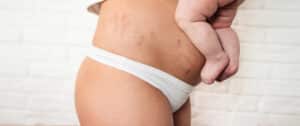 Close up shot of a mother holding her new baby with her stomach and stretch marks visible, in need of surgery