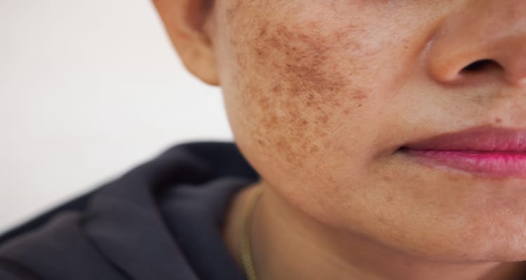 Woman with dark pigmentation on cheeks which could be treated with J Plasma