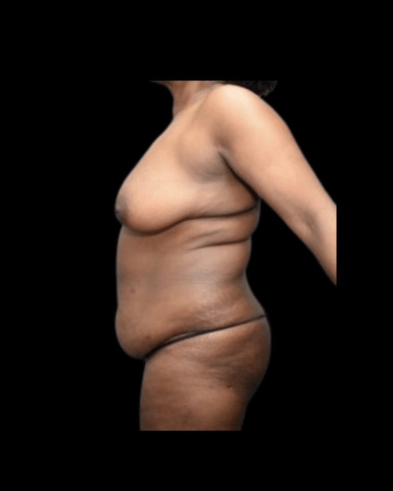 Before Image: Abdominoplasty/Tummy Tuck Patient #11 - front