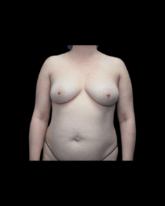 Before Image: Breast Reduction Patient #4
