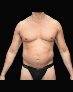 Before Image: Liposuction Patient #9