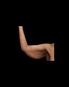 Before Image: Brachioplasty & Breast Augmentation (Implants) Patient #1