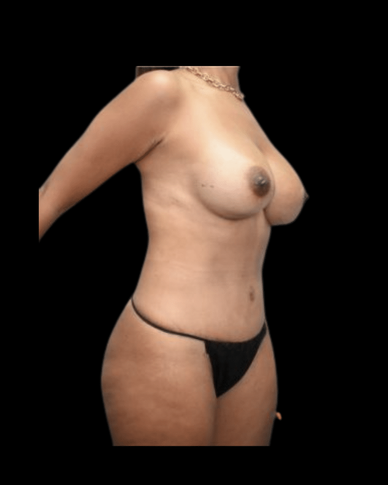 After Image: Abdominoplasty/Tummy Tuck Patient #12 - right-front-oblique