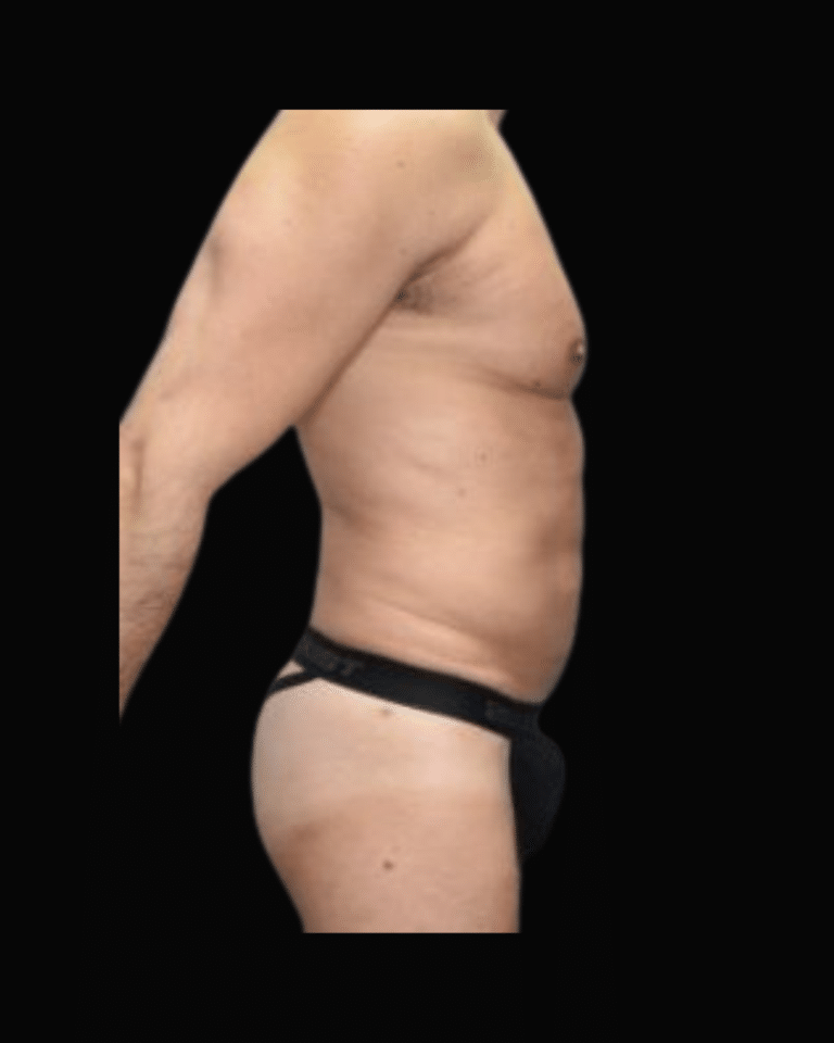 After Image: Liposuction Patient #9 -