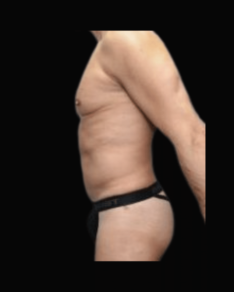 After Image: Liposuction Patient #9 -