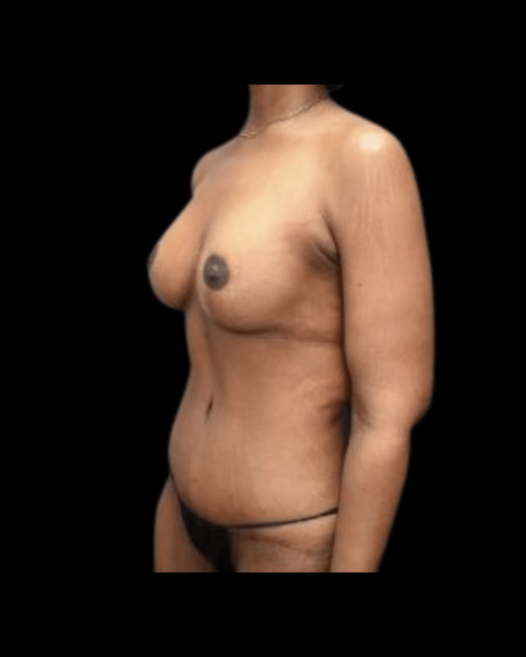 After Image: Brachioplasty & Breast Augmentation (Implants) Patient #1 - front