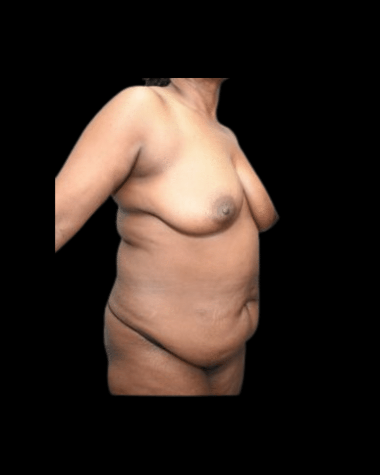 Before Image: Abdominoplasty/Tummy Tuck Patient #11 - right-side