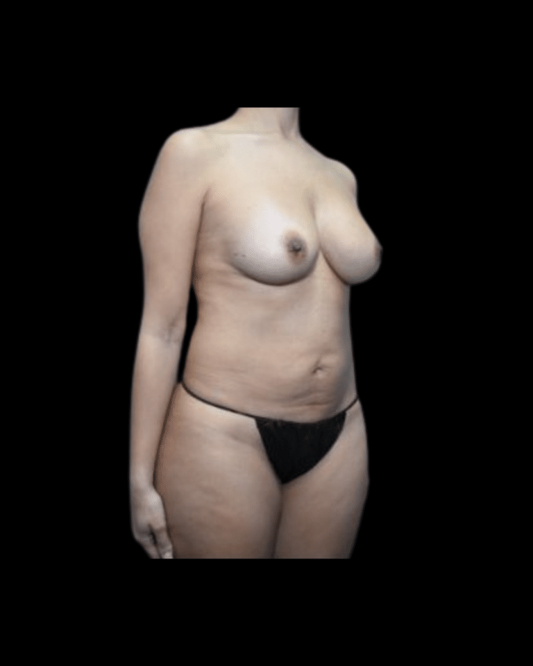 Before Image: Abdominoplasty/Tummy Tuck Patient #12 - right-front-oblique