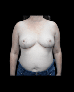After Image: Breast Reduction Patient #4
