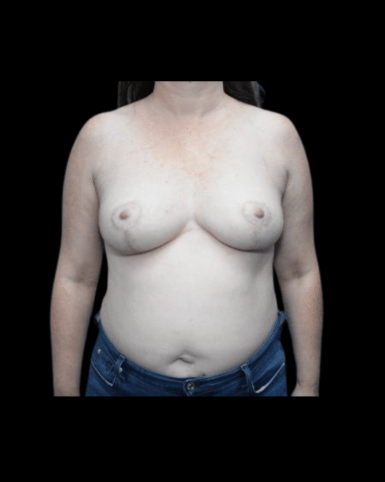 After Image: Breast Reduction Patient #4 - front