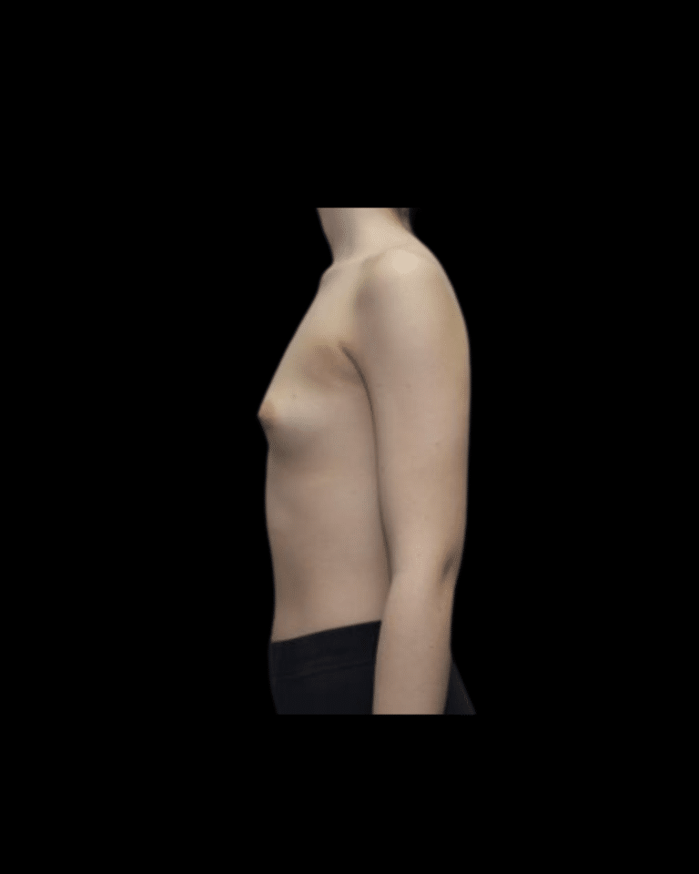 Before Image: Breast Augmentation (Implants) Patient #19 -