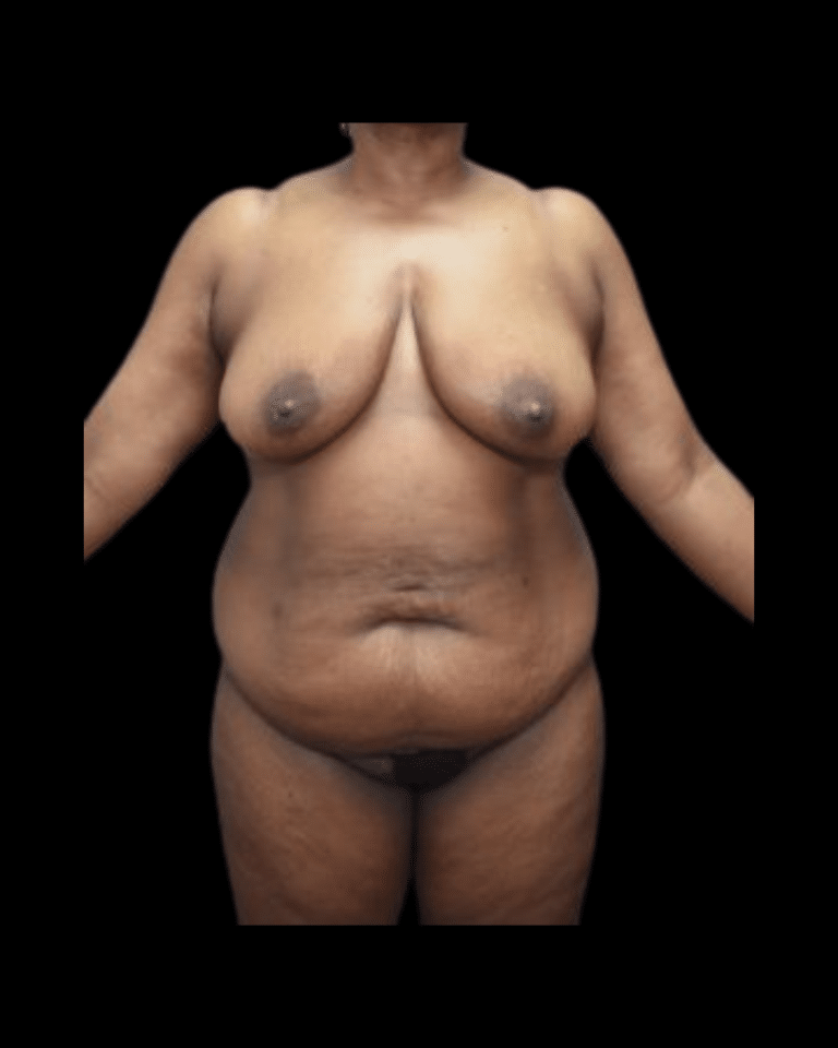 Before Image: Abdominoplasty/Tummy Tuck Patient #11 - front