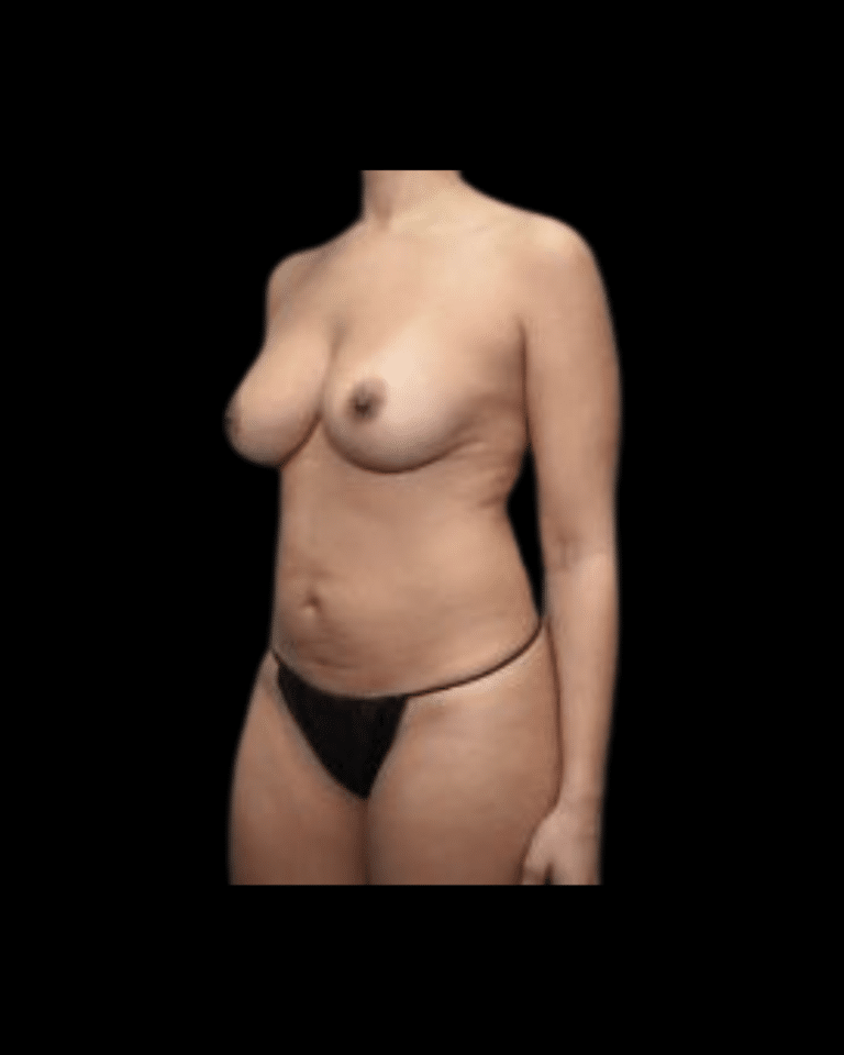 Before Image: Abdominoplasty/Tummy Tuck Patient #12 - left-front-oblique