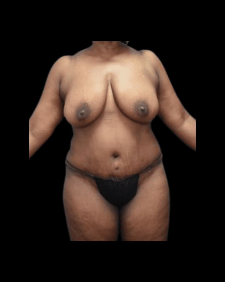 After Image: Abdominoplasty/Tummy Tuck Patient #11 - front