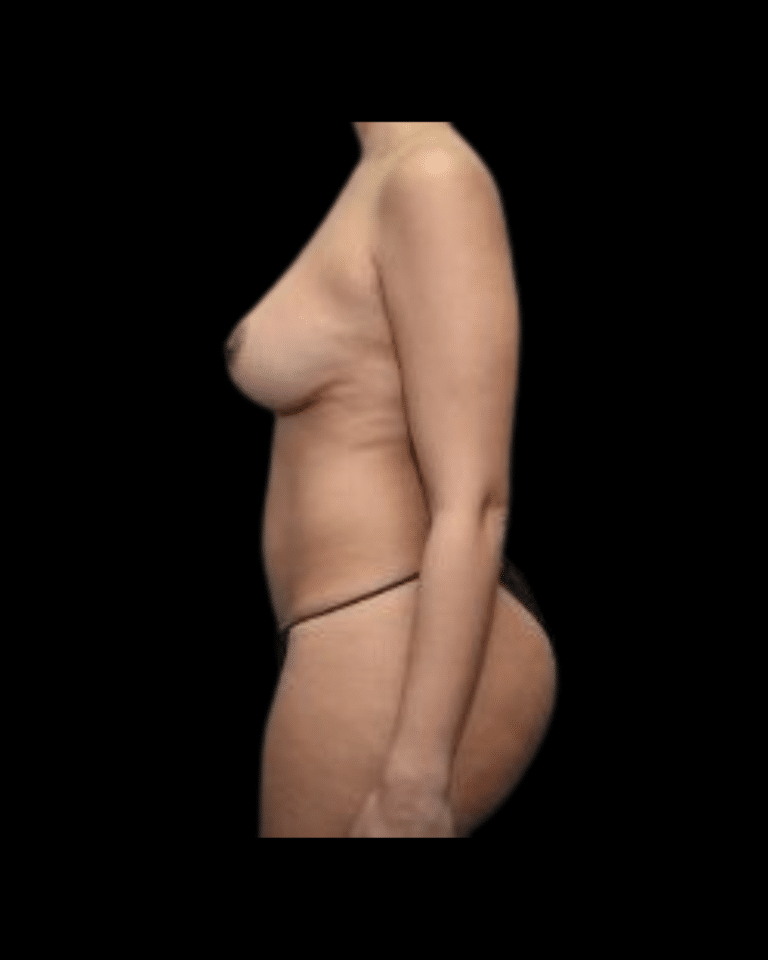 Before Image: Abdominoplasty/Tummy Tuck Patient #12 - left-side