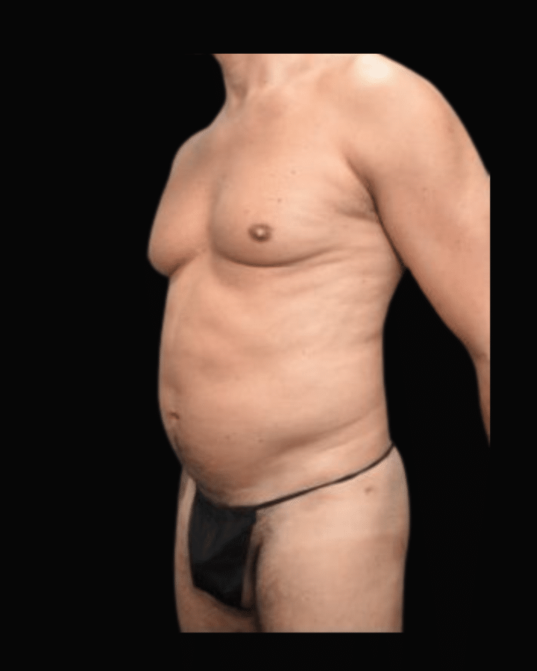 Before Image: Liposuction Patient #9 -