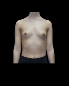Before Image: Breast Augmentation (Implants) Patient #19