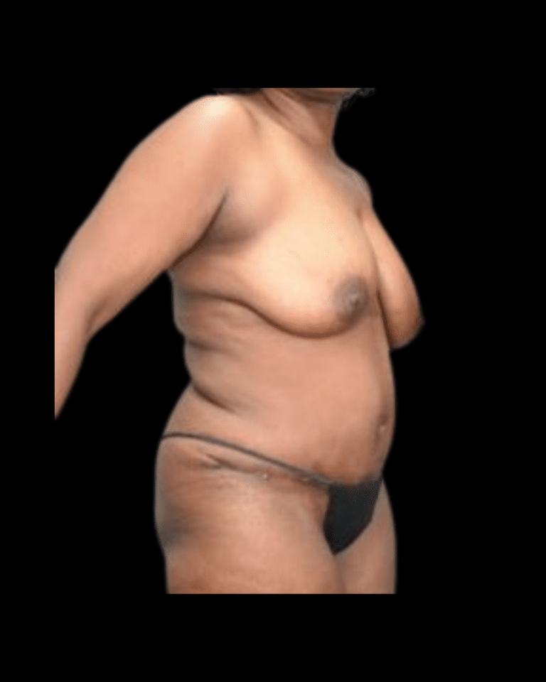 After Image: Abdominoplasty/Tummy Tuck Patient #11 - right-side