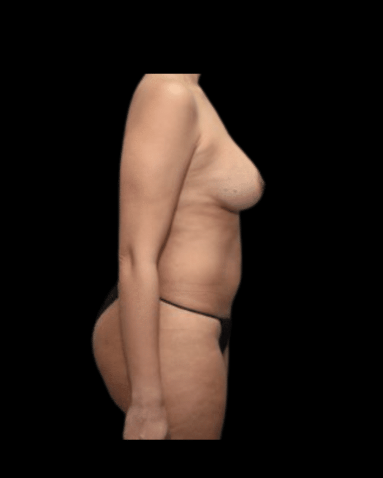 Before Image: Abdominoplasty/Tummy Tuck Patient #12 - right-side