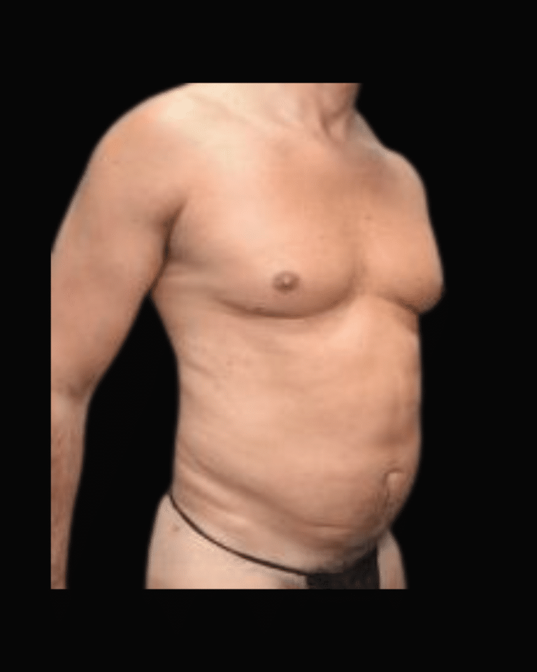 Before Image: Liposuction Patient #9 -